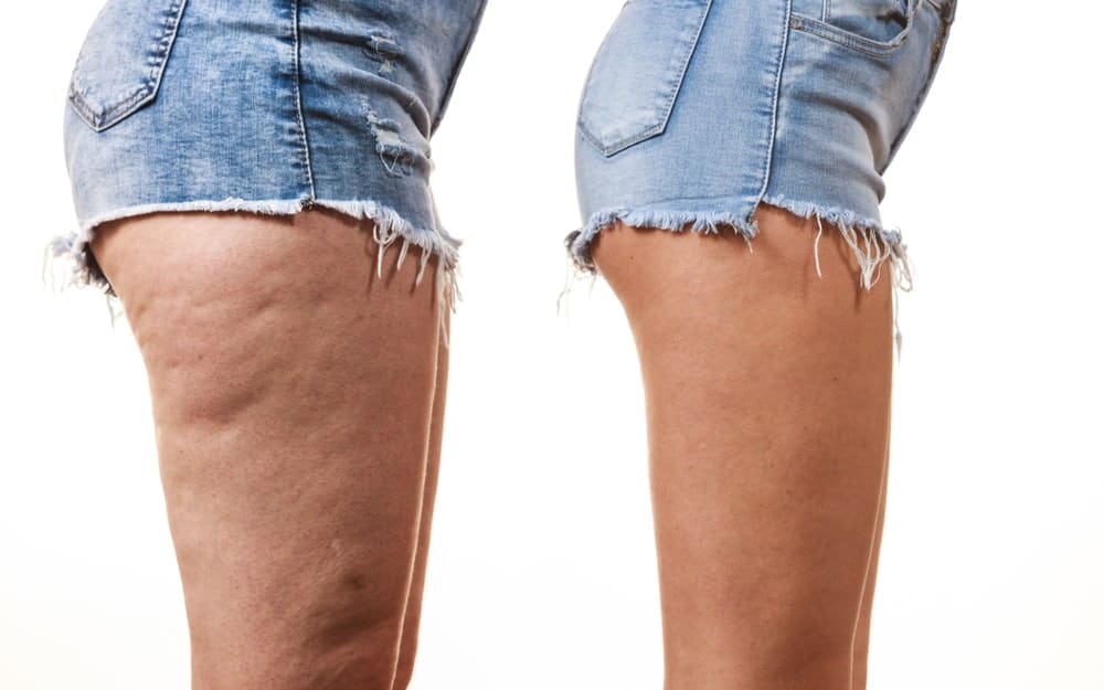 Combattre la cellulite